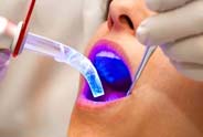 Pleasanton Ca Dental Implant Care