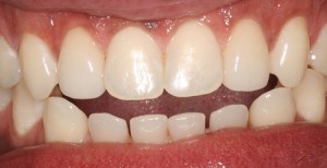 Porcelain Veneers After