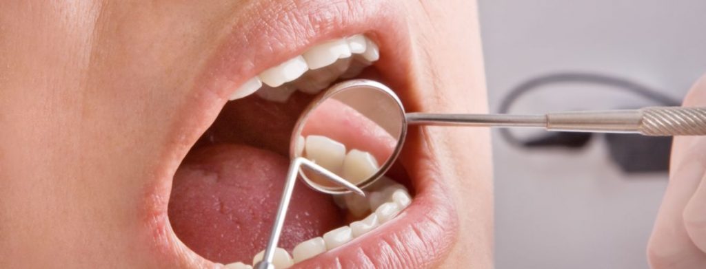 Cavity Treatment Prevention