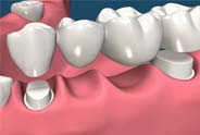 Pleasanton Ca Dental Crowns and Bridges