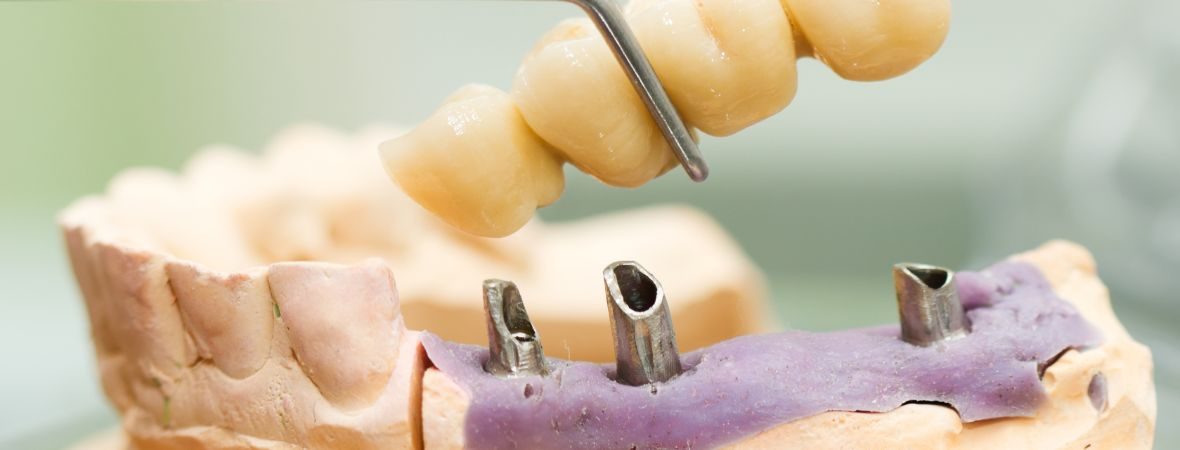 Dental Bridges