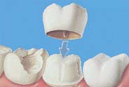 Pleasanton Ca Dental Crown