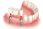 Pleasanton Ca Dental Crowns and Bridges