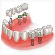 Pleasanton Ca Dental Bridge