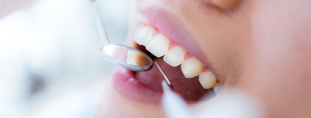 5 Reasons Dental Crown