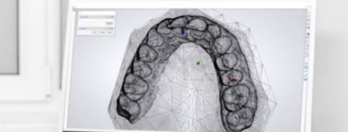 Laser Dental Scanner