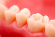 Pleasanton Ca Dental Crowns and Bridges