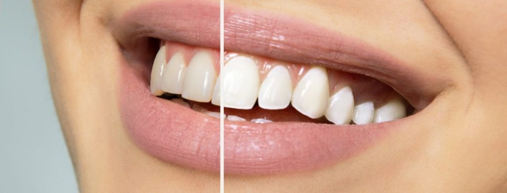 Teeth Whitening