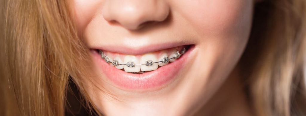 Teeth Whitening Braces