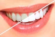 Teeth Whitening Pleasanton, CA