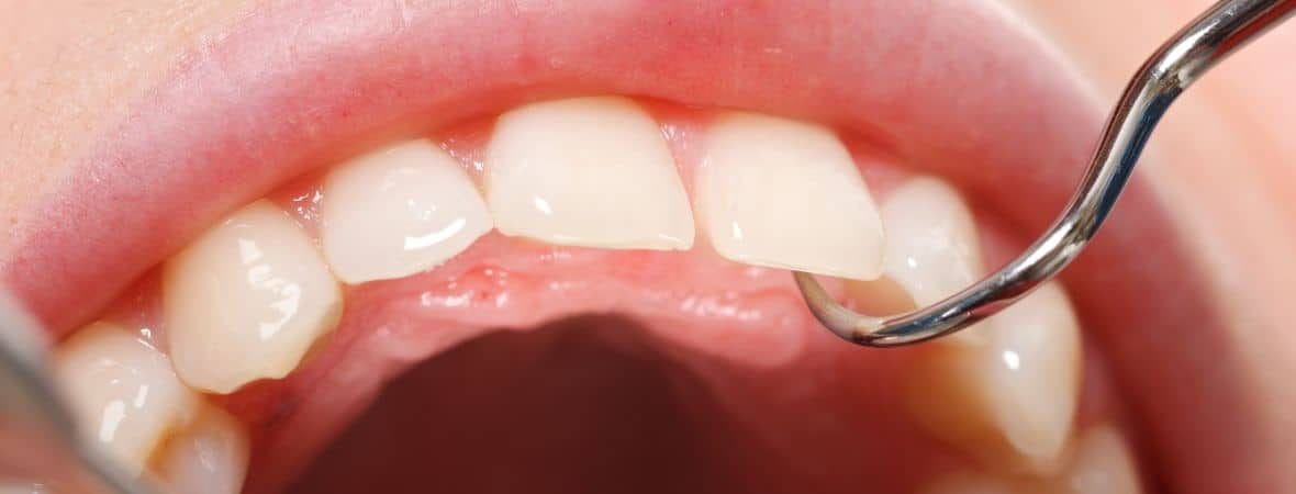 Tooth Enamel Wear