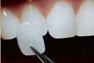 Pleasanton Ca Dental Crowns and Bridges